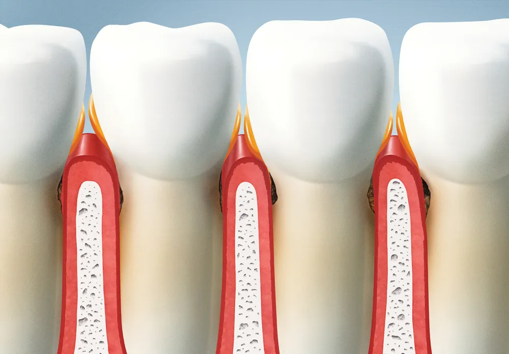 Gingivitis