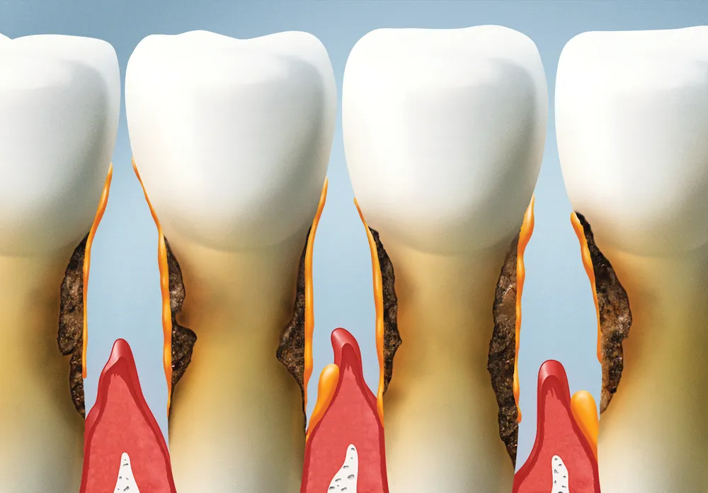 Periodontitis avanzada