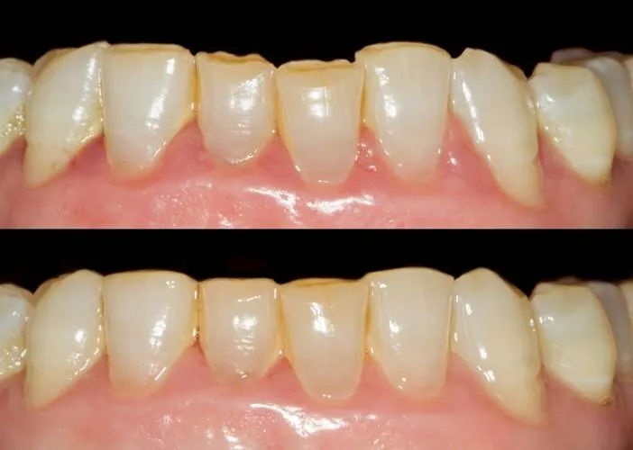 Contorneado dental