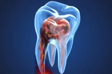 Endodoncia Endodoncia