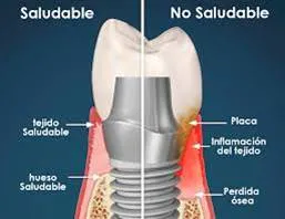 Implante saludable frente a no saludable