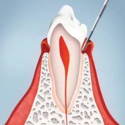 Curetajes periodontales