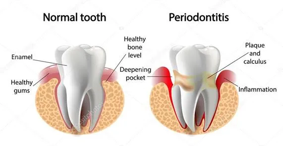 Diente sano frente a periodontitis