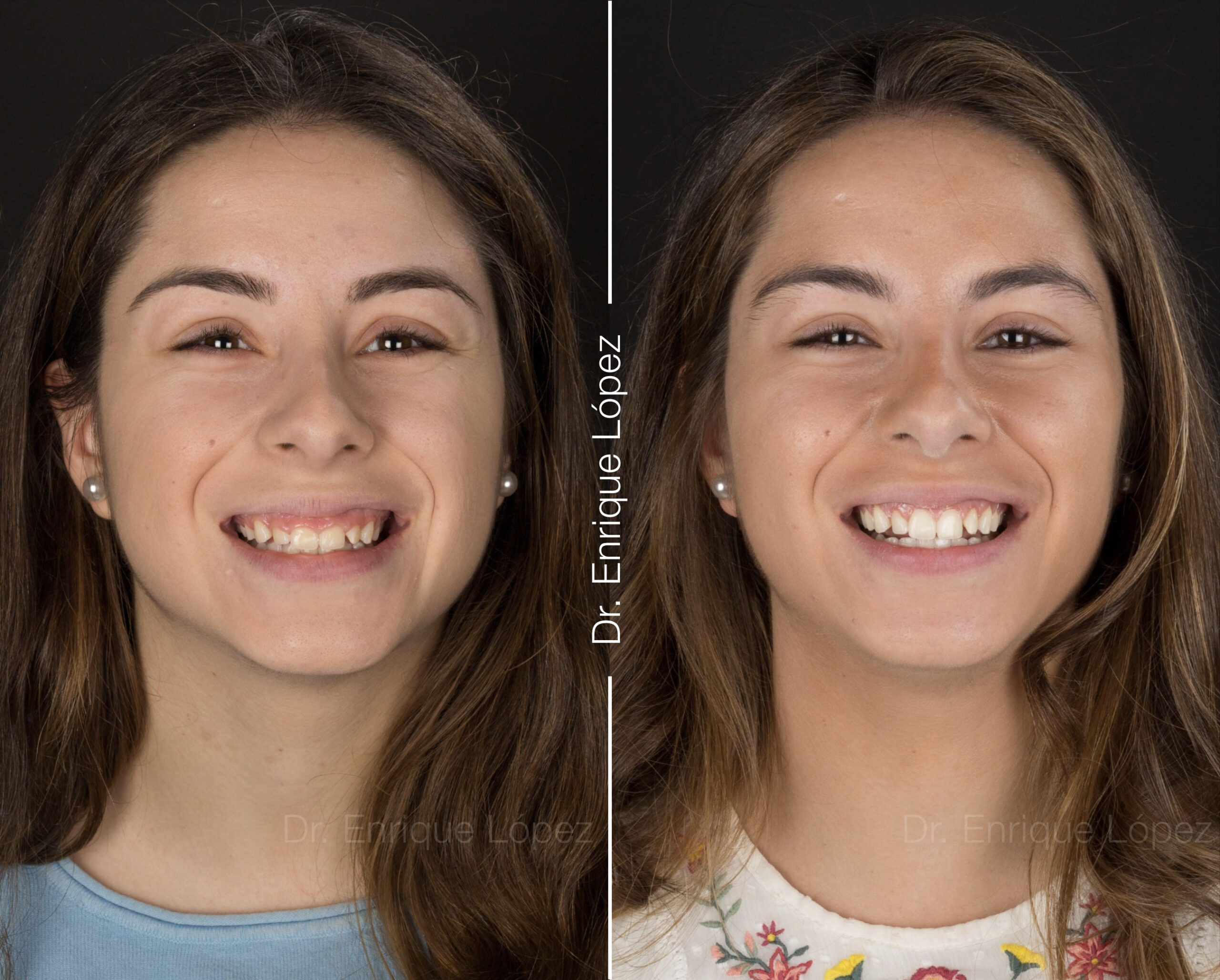 Foto comparativa 1