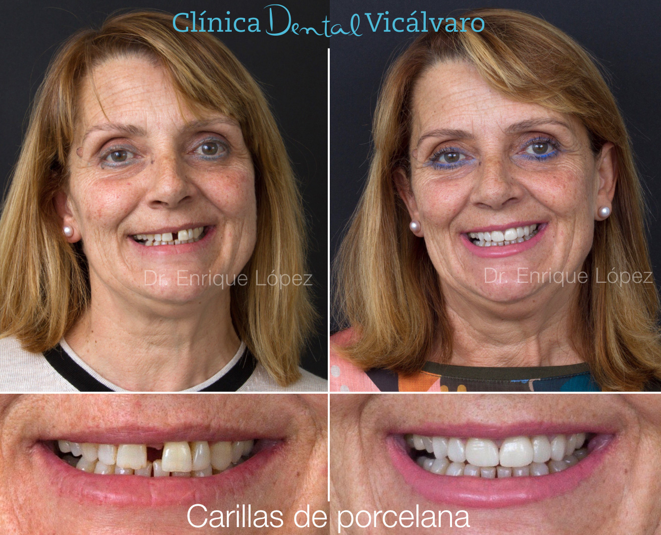 Imagen del caso "carillas de porcelana"