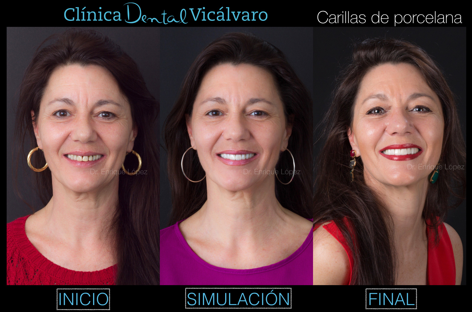 Imagen del caso "carillas de porcelana"