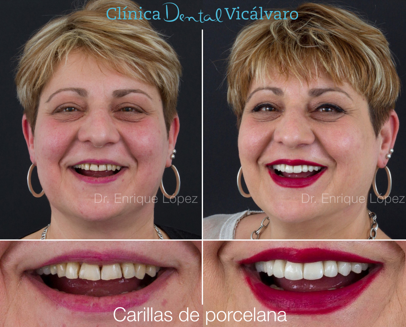 Imagen del caso "carillas de porcelana"