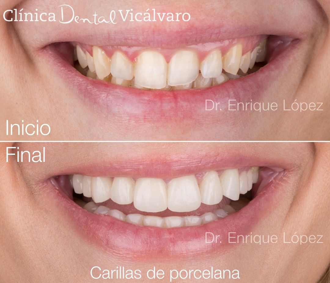 Imagen del caso "carillas de porcelana"