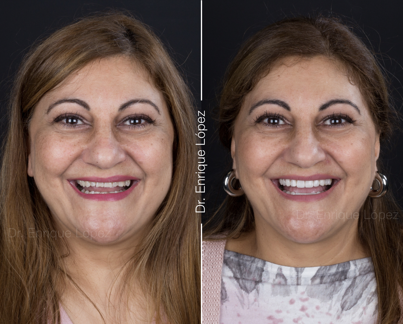 Foto comparativa 1