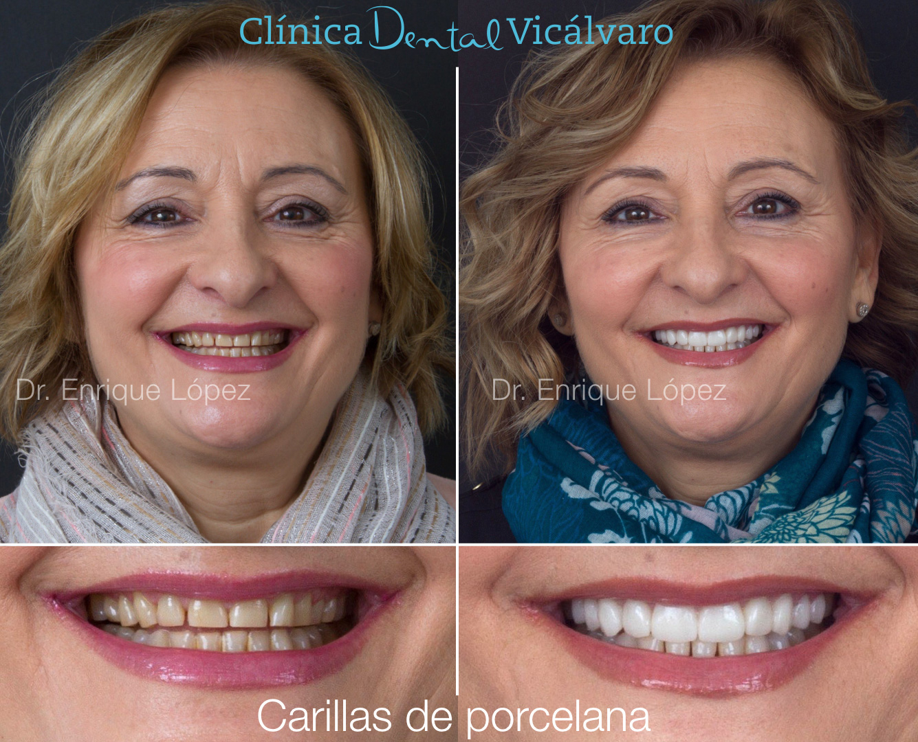 Imagen del caso "carillas de porcelana"