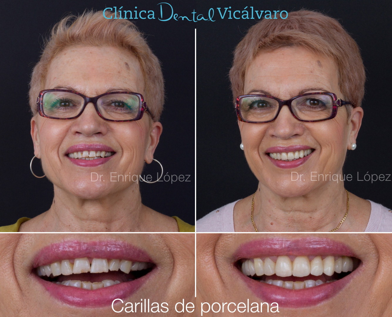 Imagen del caso "carillas de porcelana"