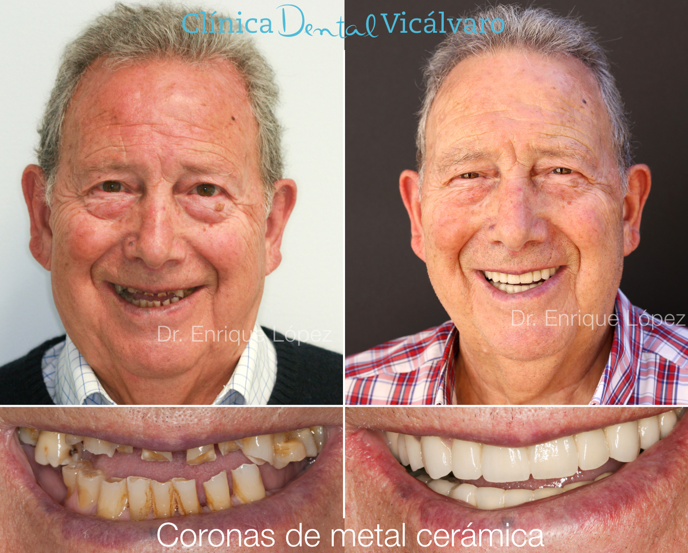 Imagen del caso "coronas de metal cerámicas"