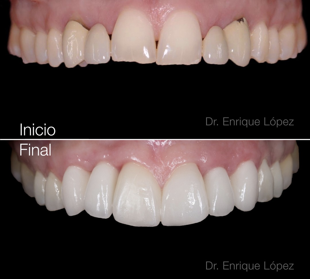 Imagen del caso "ortodoncia, implantes y carillas"