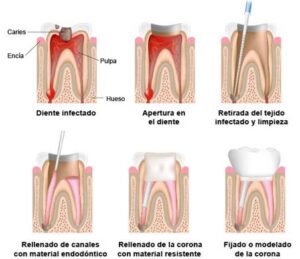 endodoncia